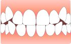 歯のでこぼこ